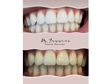Densite Marrakech - Dentist marrakech - طبيب اسنان مراكش